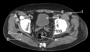 The video covers the most. Axial Computed Tomography Of A Male Pelvis In The Portal Venous Phase Post Contrast The Bmj