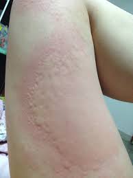 Image result for Papular urticaria