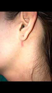 (yep, those exist too.) knowing the difference can help you treat whatever is happening on your ear and hopefully prevent it. Skin Concern Off And On Behind And Under Ear Redness And Pimples Not Sure What The Cause Is Skincareaddiction