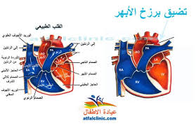 تضيق برزخ الأبهر Coarctation Of The Aorta عيادة الأطفال نابلس