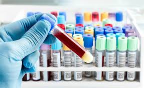 Approved by the cancer.net editorial board, 03/2020 a tumor marker is a substance found in your blood, urine, or body tissue. Ca 19 9 Pancreatic Cancer Action Network