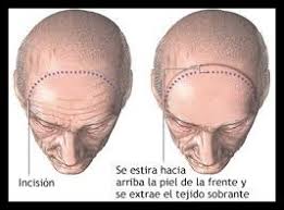 Resultado de imagen de cicatrices lifting frontal