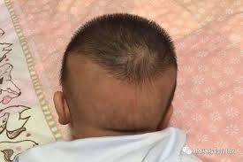 Calcium is also important for your hair, and if you are not getting enough vitamin d (which is needed for absorbing calcium), your hair may fall out. Alopecia Occipitalis Calcium Deficiency Talk About The Baby S Bald Pillow Daydaynews
