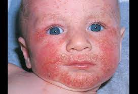 Atopic Dermatitis Symptoms Causes Vs Eczema Remedies Treatment