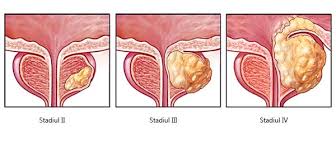 Oboseală instalată pe fondul trezirilor dese noaptea. Cancerul De Uretra Cancer De Uretra