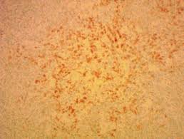 Vincent's hospital, melbourne, vic, australia; Angioimmunoblastic T Cell Lymphoma Dermnet Nz