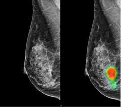 A ct scan is one of the most frequently utilized exams to detect cancer and to show things such as a tumor's shape and size. Ai Assisted Radiologists Can Detect More Breast Cancer With Reduced False Positive Recall Imaging Technology News