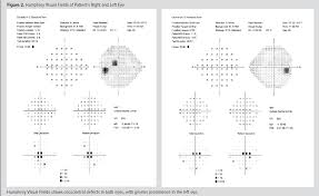 Pdf A Case Of Optic Neuritis Secondary To Lyme Disease Semantic Scholar