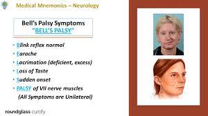 Though symptoms range in severity and duration, most cases improve and resolve after a few weeks. How Would You Remember All The Symptoms Of Bell S Palsy