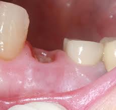 Fees for pulling teeth, by extraction type: How Much Is A Tooth Extraction Compare Average Cost