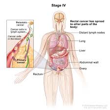 They may not recognize you or may seem upset and out of sorts for no apparent reason. Rectal Cancer Hematology Oncology Associates Of Cny