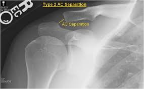 Image result for Shoulder History