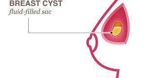 A breast lump can be one symptom of cancer, but not all breast cancer cases involve a lump. Breast Cyst National Breast Cancer Foundation