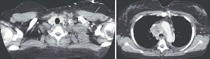 However, these nodes mainly drain structures in the thorax and abdomen. A Ct Neck With Contrast Showing Left Supraclavicular Lymph Node Download Scientific Diagram