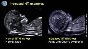 A dating scan is an ultrasound examination which is performed in order to establish the gestational age of the pregnancy. Nuchal Translucency Nt Youtube