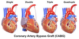 Illustration Depicting Single Double Triple And Quadruple Bypass Bypass Surgery Coronary Arteries Cardiothoracic Surgery