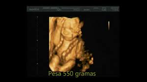 Medipedia Feto Com 5 Meses 3d 4d Em Tempo Real Ultrassonografia Youtube
