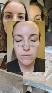 Chemical peel season is almost over. Book ASAP to get glowy skin before  summer ☀️ , #Omahachemicalpeel #omahamedspa #skincorrection  #Stillaesthetics #omahanebraska #vipeelprecisionplus #vipeel
