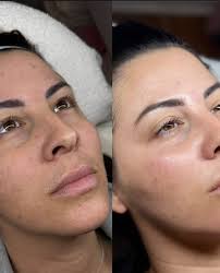 PRX Derm Profection. A topical biostimulator. Tighten the skin. Achieve  healthy luminosity. Improve sun damage. #prxdermperfexion #prxperformance  #wico #prx #prxdermperfexion