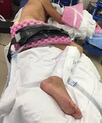 Image result for Intrathecal Pump