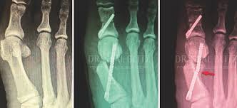 So, many people put off fixing their bunion until they. How To Handle Complications With Minimally Invasive Bunion Surgery Podiatry Today