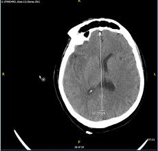 Severe infection, particularly untreated herpes simplex virus (hsv) encephalitis, can cause brain hemorrhagic necrosis. Cureus Herpes Simplex Virus Encephalitis Atypical Presentation As A Right Middle Cerebral Artery Stroke