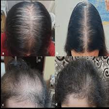 Image result for HAIR Score