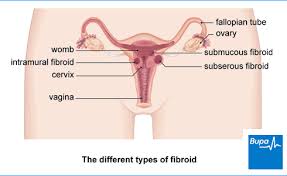 Image result for fibroid