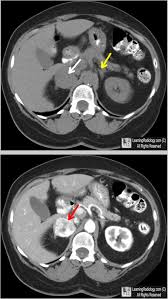 Pheochromocytoma Pre Contrast Axial Ct Of Abdomen Shows A Mass In The Right Adrenal Gland White Arrow The Left Adren Radiology Imaging Radiology Radiography