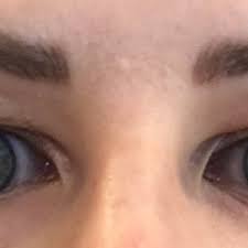 Check spelling or type a new query. I Want To Correct Hooding Open Up My Eyes What Is The Right Procedure Form What Type Of Surgeon Do I Need Photo