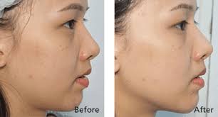We did not find results for: Hifu Facelift Sygmalift Cambridge Therapeutics
