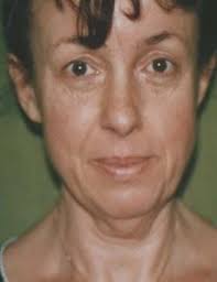 Plastic Surgery in Prague