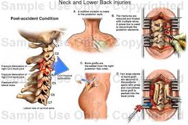 Pelvic inflammatory disease, inflammation of the sexual organs that causes pain to radiate to the back. Neck And Lower Back Injuries Medical Illustration Human Anatomy Drawing Anatomy Illustration