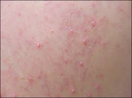 Image result for pruritic urticarial papules and plaques of pregnancy