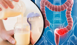 The feeling that you have not emptied your bowel properly is a sign (image: Bowel Cancer Treatment Could Human Breast Milk Be A Cure Express Co Uk