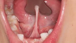 Frenectomia cirurgia oral Guará Brasília