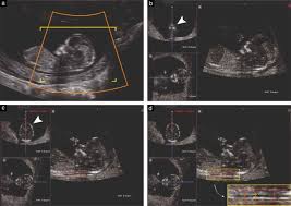 It allows to primarily determine if the baby runs a risk factor of being born with down's syndrome. Comparison Of Nuchal Translucency Measurements Obtained Using Volume Nttm And Two And Three Dimensional Ultrasound Cho 2012 Ultrasound In Obstetrics Amp Gynecology Wiley Online Library