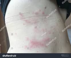 Image result for zoster under breasts