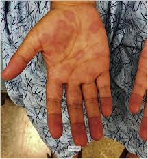 See more ideas about doggy, piggy, roblox. Multisystem Inflammatory Syndrome In Children Mis C In An Adolescent That Developed Coronary Aneurysms A Case Report And Review Of The Literature Journal Of Emergency Medicine