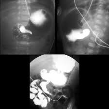 Image result for Midgut Volvulus