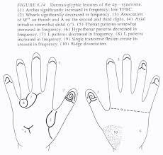 4 hand charts for cri du chat syndrome