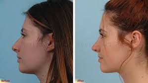 Rhinoplasty Photo Gallery