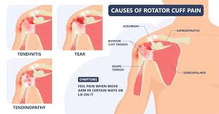 Image result for Rotator Cuff Rupture