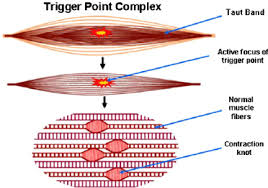 Myofascial trigger point reference including referred pain and muscle diagrams as well as symptoms caused by triggerpoints. A Cartoon Of A Trigger Point Complex Seen In A Longitudinal Section Of Download Scientific Diagram