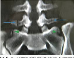 Bilateral L5 Transverse Process Fracture Implications What Every Spine Surgeon Must Know Semantic Scholar