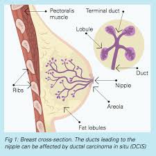 Close margins are neither positive nor negative. Ductal Carcinoma In Situ Dcis Fact Sheet Westmead Bci
