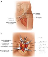 Image result for Obturator Nerve Compression