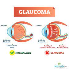 Glaucoma is a progressive vision condition that can lead to permanent blindness. Glaucoma Causes Symptoms And Treatment Netmeds