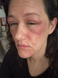 I haven't tried it myself but it might be worth a try if you're allergic.