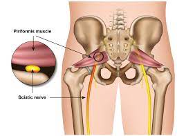 It connects the hip bone (iliac crest) and the bottom of the spine (sacrum) to the upper thigh (iliotibial band and femur). How To Tell If Your Sciatica Is Actually Piriformis Syndrome